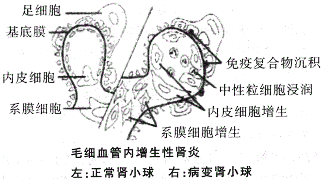 下列哪项不属于原发性肾病综合征常见的病理类型