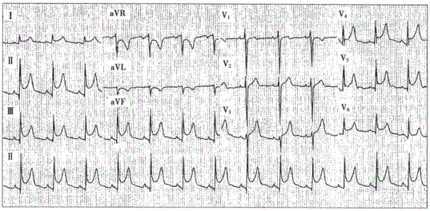 急性心包炎心电图图片